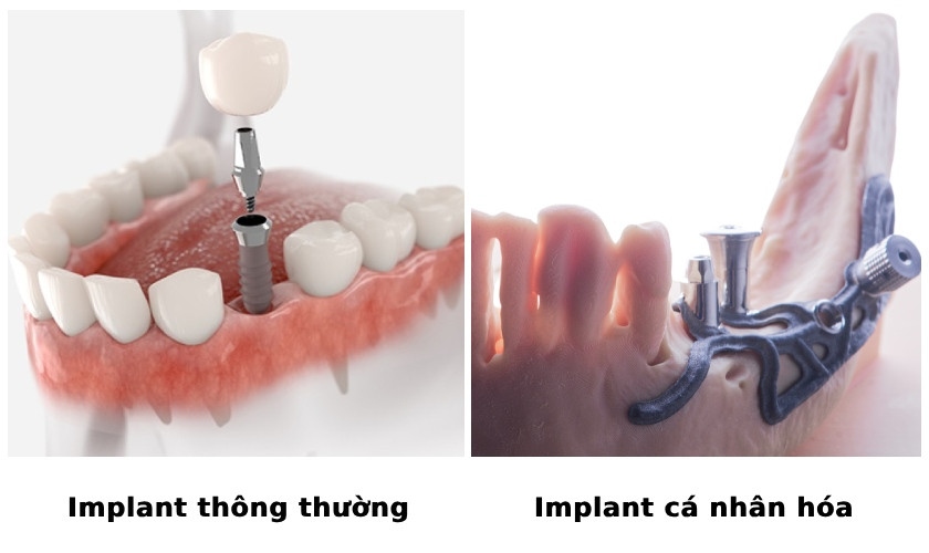 Kỹ thuật Implant cá nhân hóa được thực hiện dựa theo tình trạng khung xương hàm của từng Khách hàng thay vì cấy Implant vào xương như kỹ thuật Implant thông thường