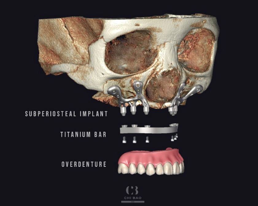 Với phương pháp Implant cá nhân hóa, khung kim loại được đặt dưới nướu và trên xương hàm (vị trí dưới màng xương), tạo nền tảng cho việc gắn cố định các trụ Implan