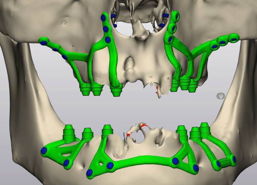 Implant cá nhân hóa được thiết kế và chế tạo dựa trên mô hình 3D của cấu trúc xương của từng khách hàng, đồng thời có sự hỗ trợ của các công nghệ hiện đại giúp tăng độ chính xác gấp 11 lần