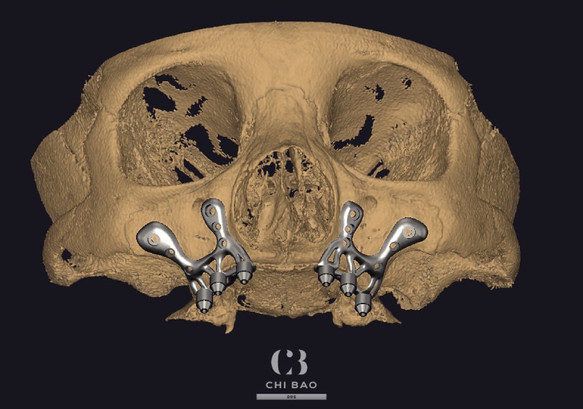 Implant cá nhân hóa cho phép loại bỏ những thủ thuật bổ trợ xương như nâng xoang, ghép xương giúp giảm thiểu tối đa sang chấn và hạn chế biến chứng,  đảm bảo an toàn cho Khách hàng