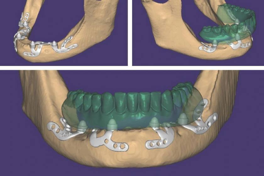 Chi phí cấy ghép Implant cá nhân hóa phụ thuộc vào nhiều yếu tố khác nhau, Khách hàng nên đặt hẹn thăm khám để được Bác sĩ tư vấn chi phí một cách chính xác