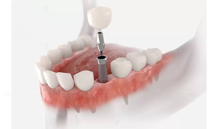 Trồng răng Implant giúp Khách hàng ăn nhai thoải mái, bền đẹp như răng thật