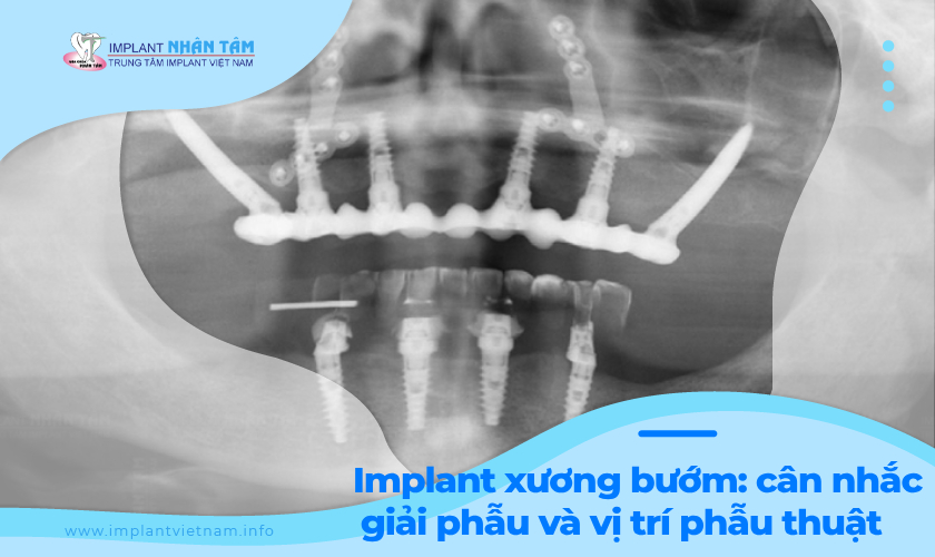 Implant xương bướm: cân nhắc giải phẫu và vị trí phẫu thuật