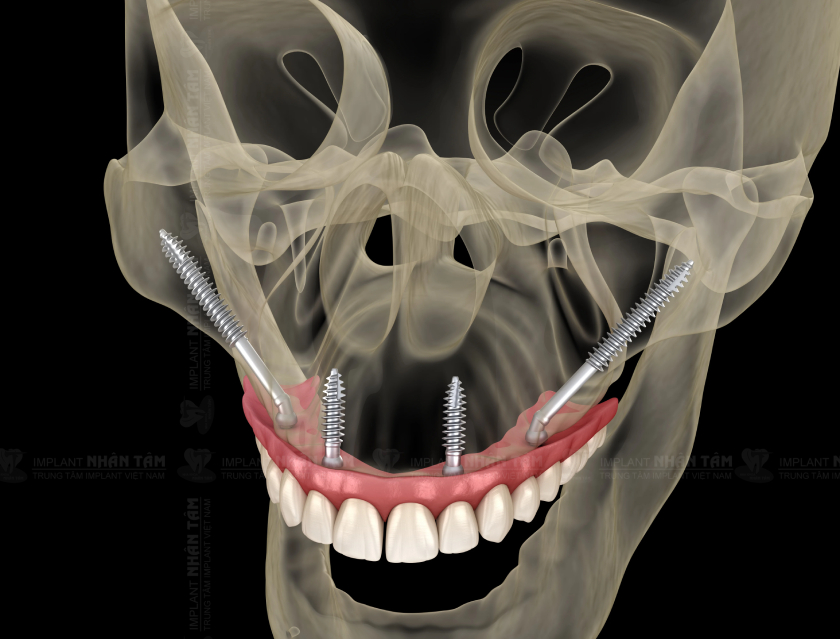 Cấy ghép Implant xương bướm sở hữu nhiều ưu điểm vượt trội