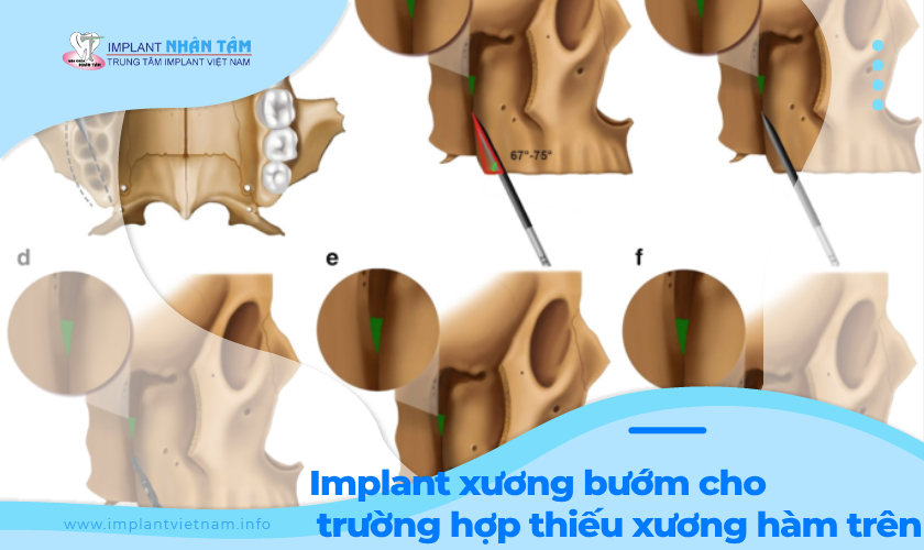 Implant xương bướm cho trường hợp thiếu xương hàm trên