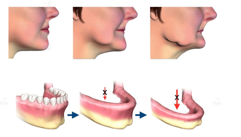 Tiêu xương hàm gây ra nhiều thách thức cho việc phục hình răng với phương pháp Implant