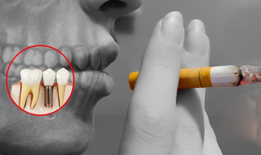 Làm răng implant có hút thuốc lá được không?