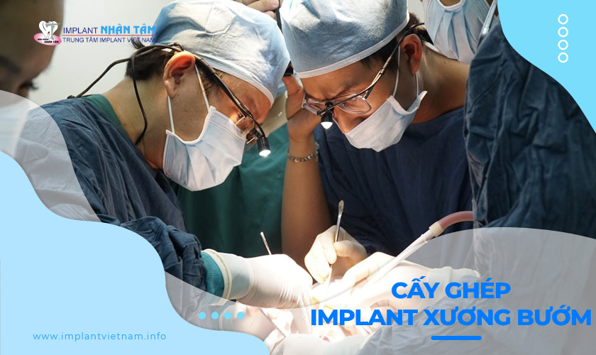 Làm thế nào để cấy ghép Implant xương bướm?