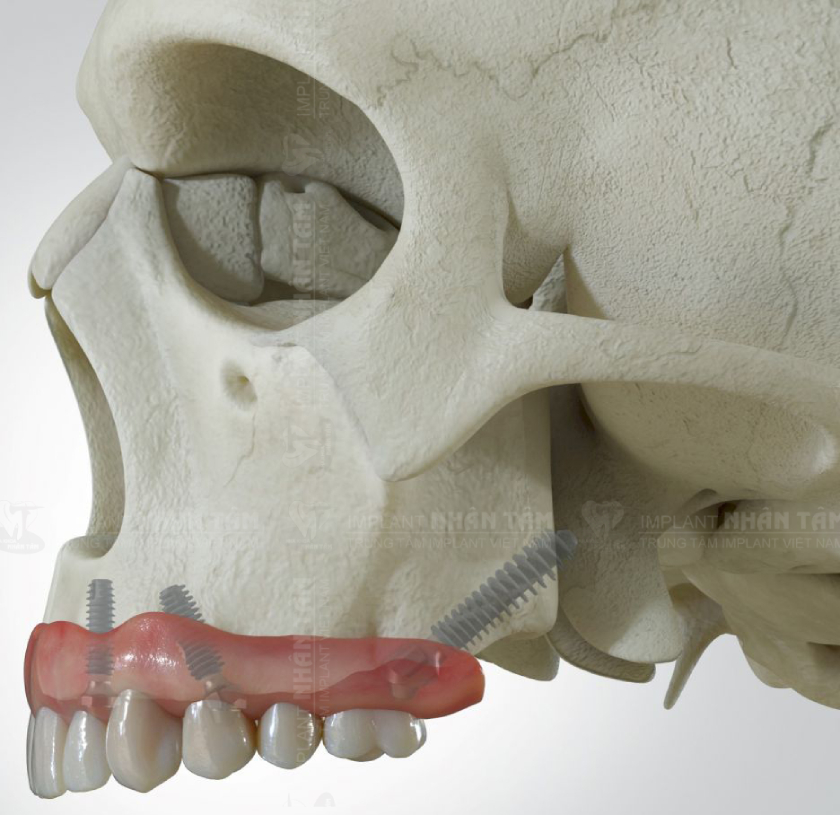 Phương pháp cấy ghép Implant xương bướm