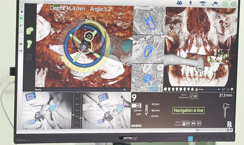 Quá trình cấy trụ Implant hiển thị trên màn hình máy tính nhờ vào công nghệ định vị X-Guide