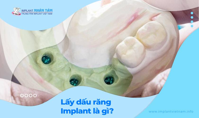 Lấy dấu răng Implant là gì? Quan trọng thế nào? Lấy dấu răng Implant là gì? Quan trọng thế nào?