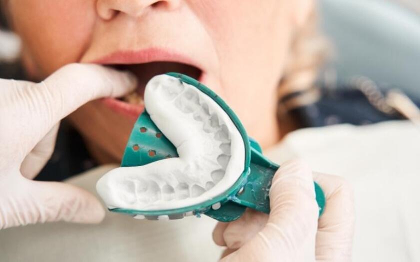 Lấy dấu răng Implant nhằm thiết kế và chế tác răng trên Implant phù hợp với khuôn răng của từng Khách hàng Lấy dấu răng Implant nhằm thiết kế và chế tác răng trên Implant phù hợp với khuôn răng của từng Khách hàng