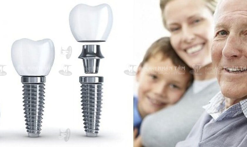 Trồng răng Implant là giải pháp điều trị tối ưu khi bị mất 2 răng liền kề