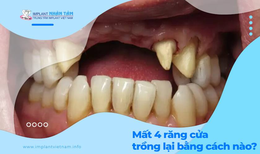 Mất 4 răng cửa trồng lại bằng cách nào tốt nhất? 