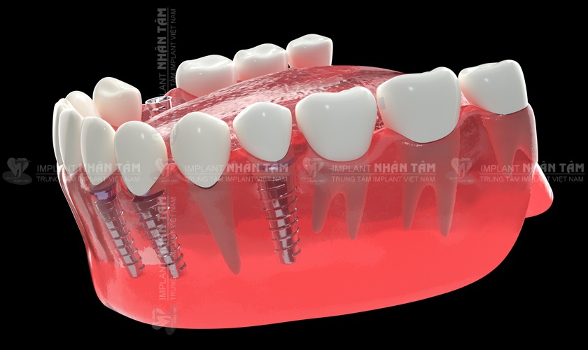 Cấy ghép răng Implant mang lại nhiều lợi ích vượt trội