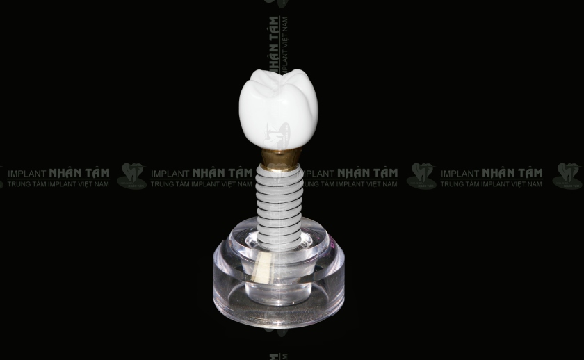 Răng Implant có cấu trúc tương đồng răng thật