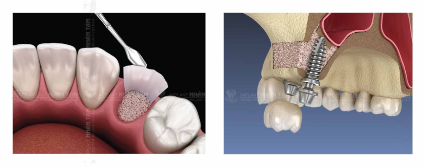 Khép xương và nâng xoang trong điều trị tiêu xương hàm