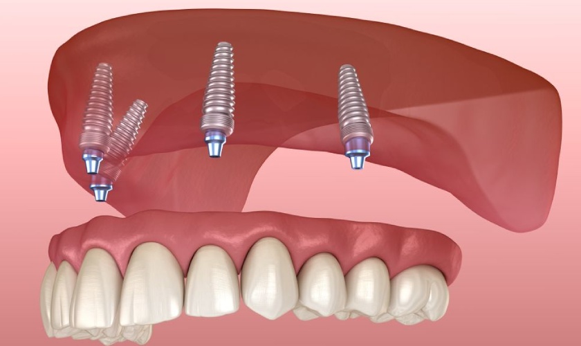 Mất răng có nhất thiết phải cấy Implant không?