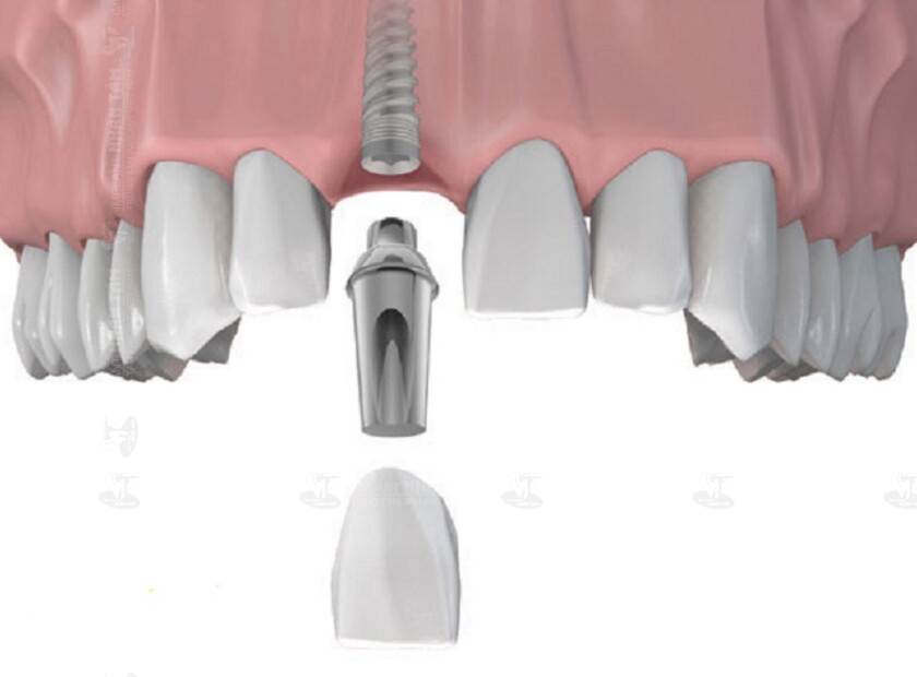 Trồng răng Implant vùng răng cửa
