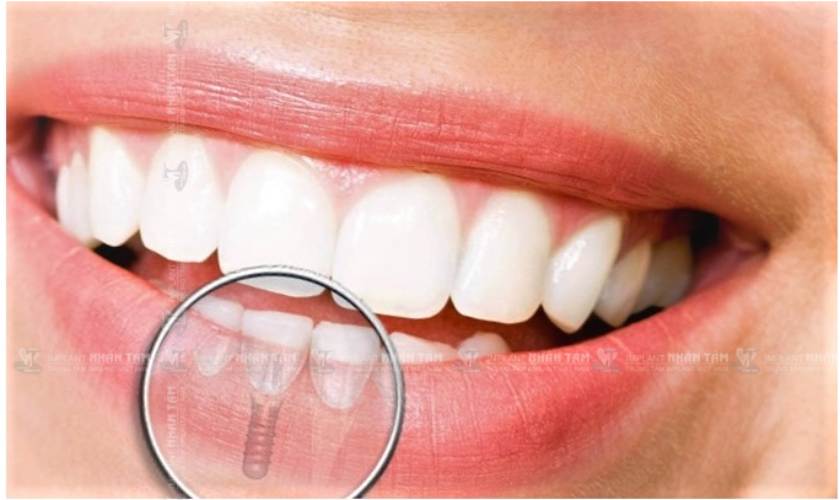 Cấy ghép Implant răng cửa giúp phục hồi thẩm mỹ hoàn hảo