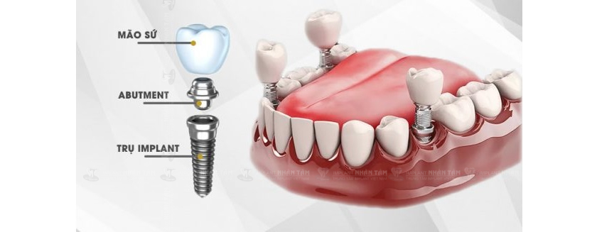 Răng Implant có cấu tạo tương tự răng thật, được cấy trực tiếp vào xương hàm, đảm bảo ăn nhai chắc chắn và thẩm mỹ tự nhiên