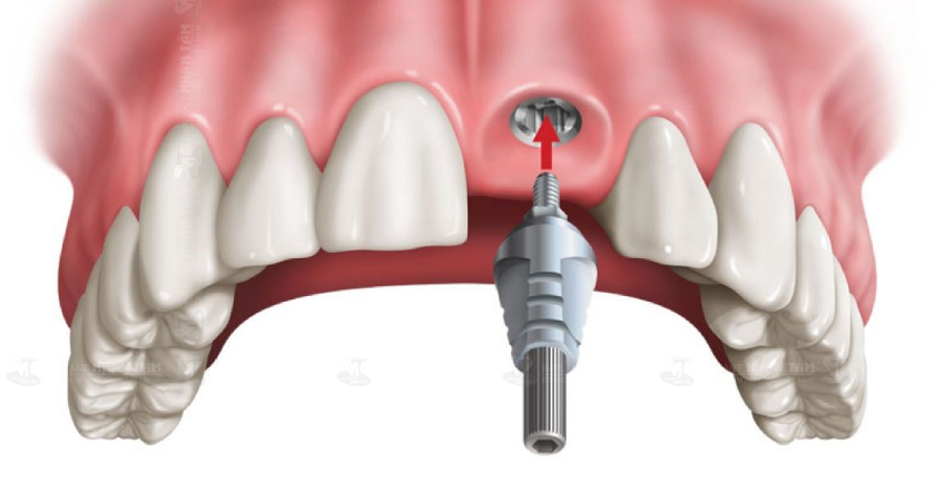 Răng Implant tồn tại độc lập, chỉ tác động vào vị trí răng bị mất, không cần mài răng hay dùng răng khác để giữ