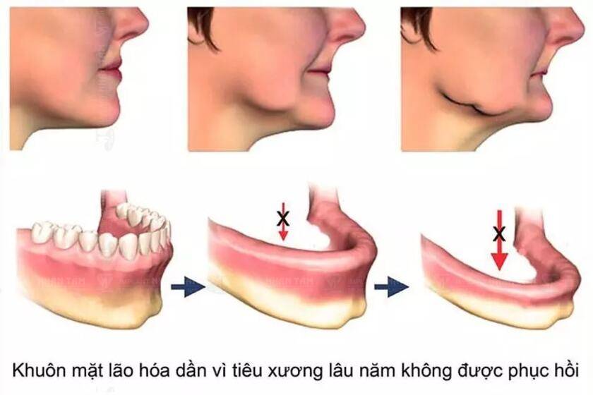 Mất răng gây tiêu xương hàm, dẫn đến mặt biến dạng và lão hóa