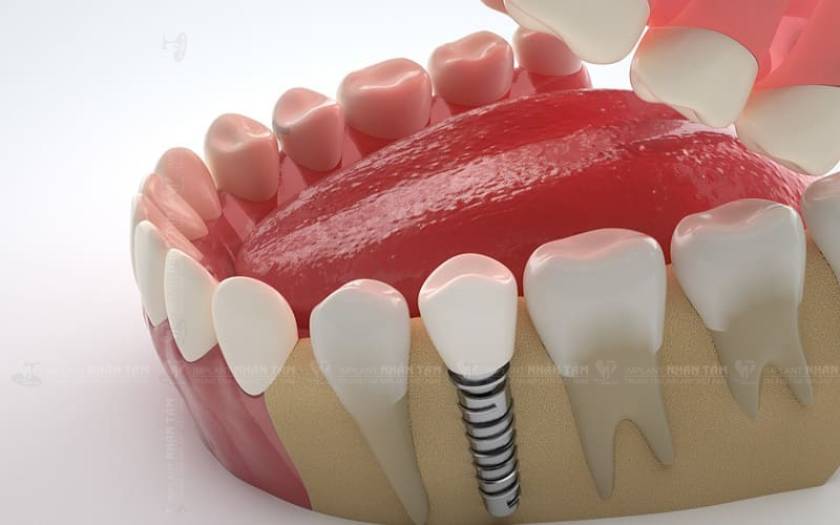 Cấy ghép Implant là giải pháp phục hình răng hoàn hảo