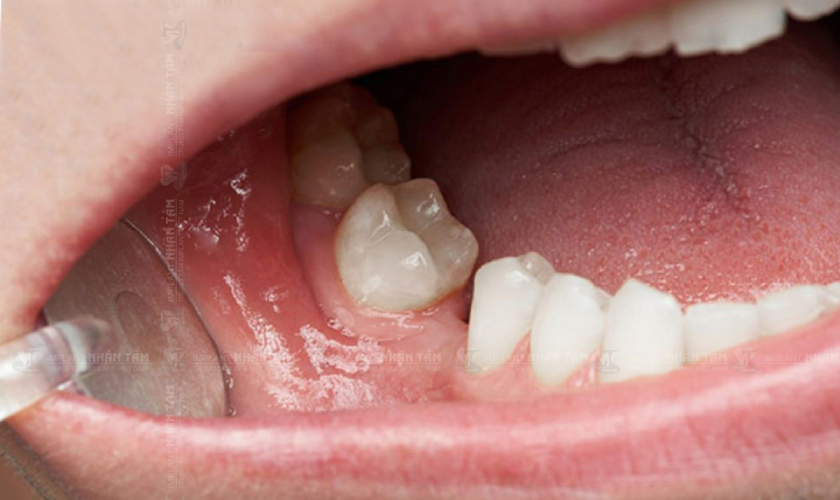 Mất răng hàm lâu năm trồng lại bằng cách nào?