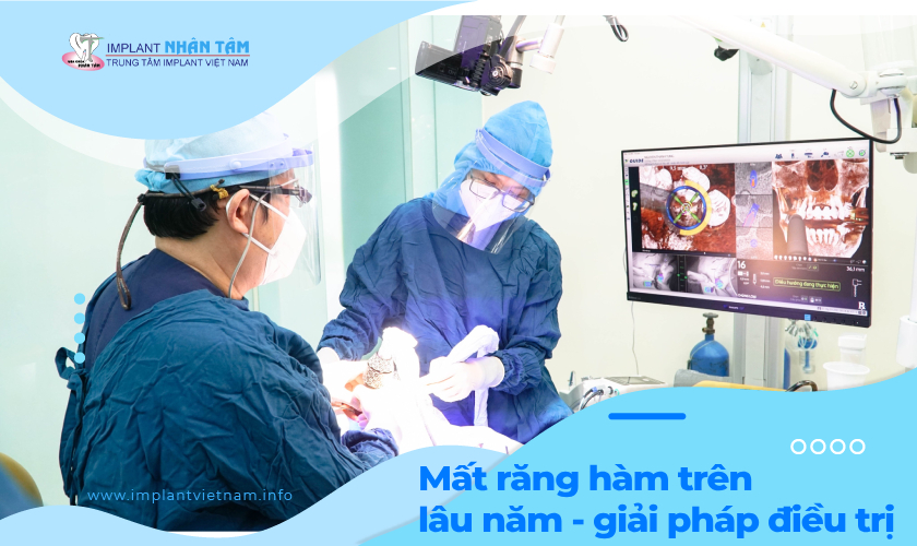 Mất răng hàm trên lâu năm: Điều trị với Implant xương bướm