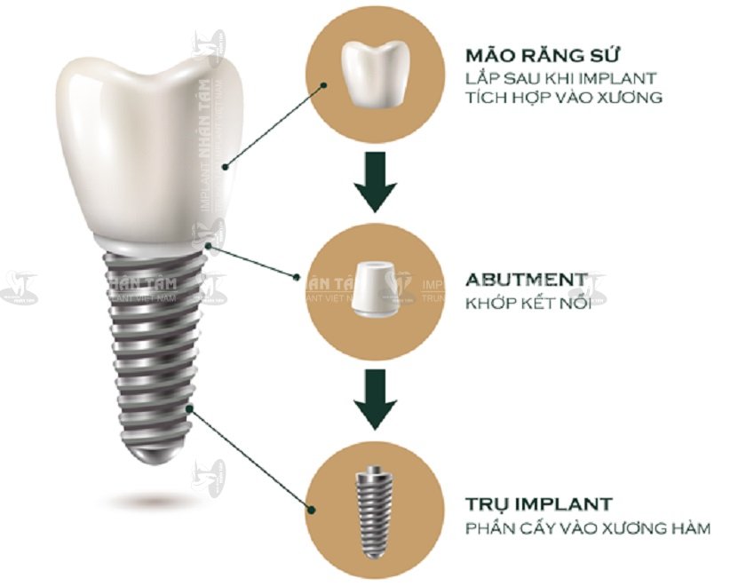 Cấu tạo của răng Implant tương đồng với răng thật