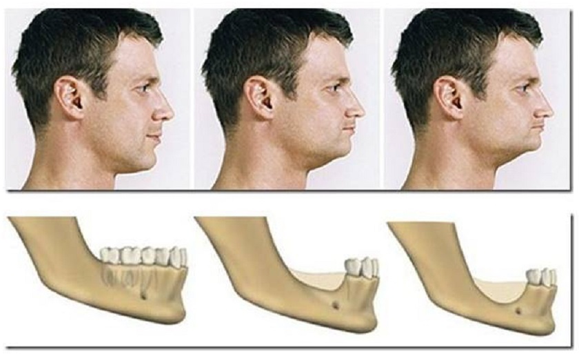 Khuôn mặt bị biến dạng do mất răng lâu năm