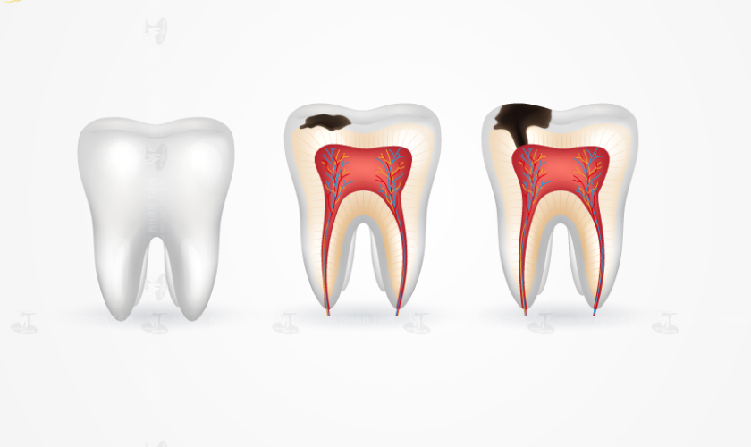 Sâu răng là bệnh lý răng miệng gây mất răng thường gặp nhất