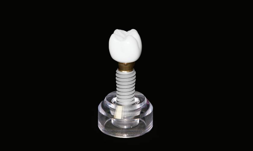 Trồng răng Implant là giải pháp toàn diện khi bị mất răng