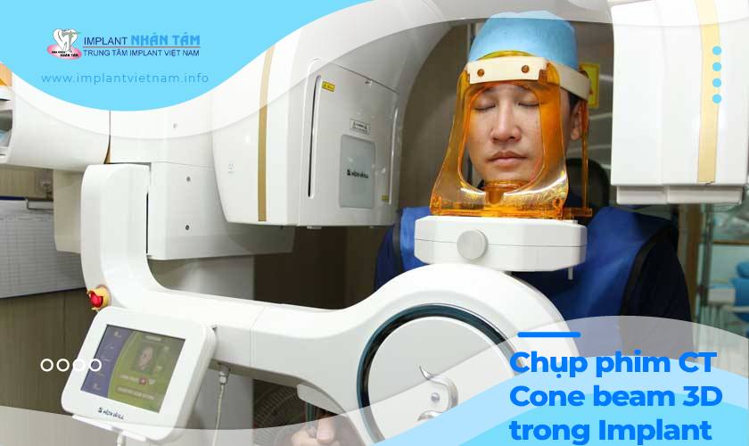 Máy chụp phim Cone Beam CT trong trồng răng Implant là gì?