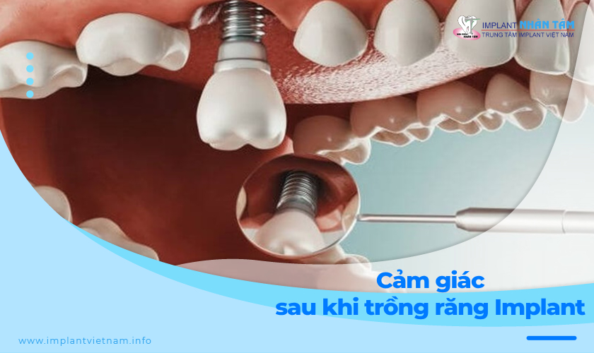 Những cảm giác sau khi trồng răng implant