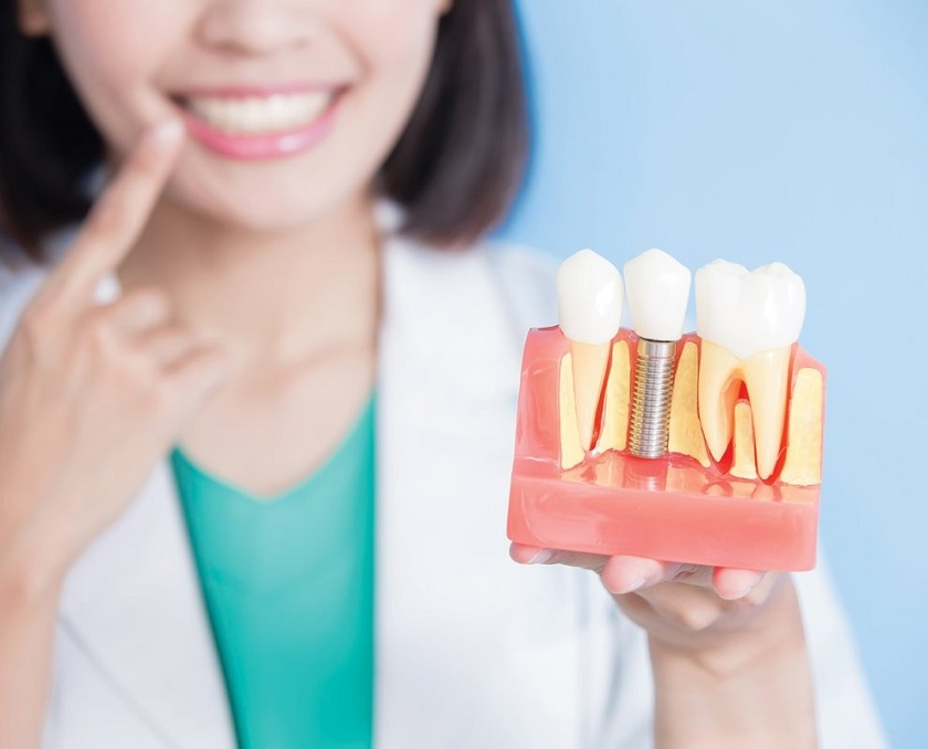 Trồng implant không ảnh hưởng đến các răng kế bên