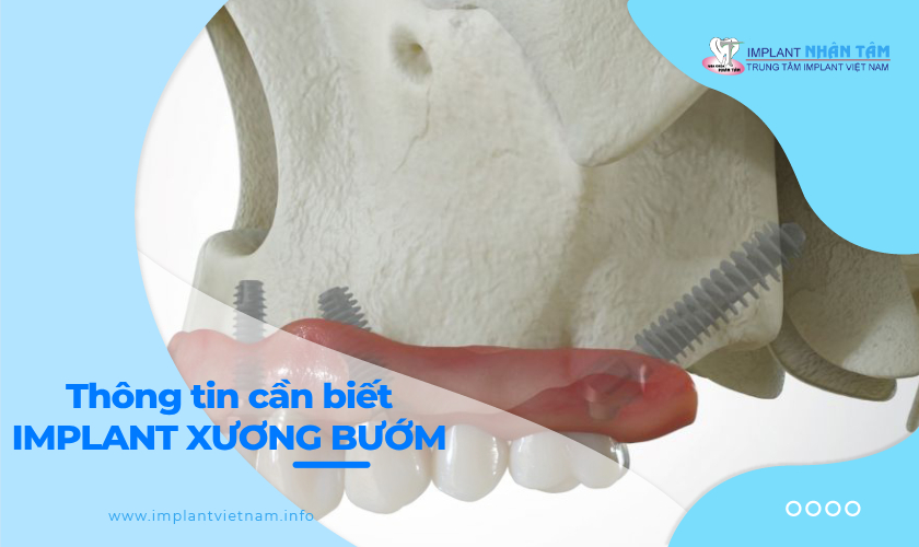 Những điều cần biết về Implant xương bướm 