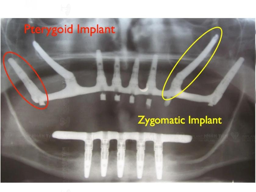 Implant xương gò má dài hơn Implant xương bướm và thường được chỉ định cho những trường hợp phức tạp hơn, tiêu xương nghiêm trọng hơn