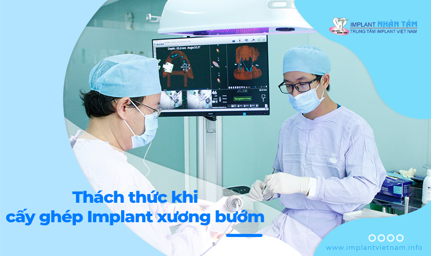 Những thách thức khi cấy ghép Implant xương bướm