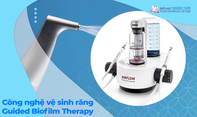 Lợi ích khi ứng dụng công nghệ Guided Biofilm Therapy