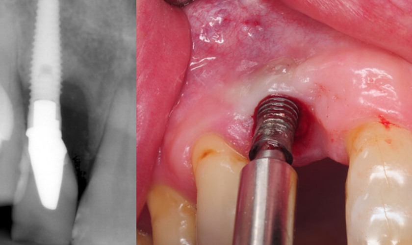 Nhiễm trùng sau cấy ghép răng Implant ảnh hưởng nghiêm trọng đến kết quả điều trị