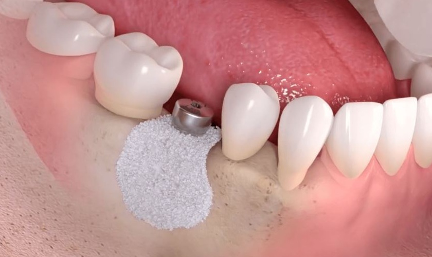 Trồng răng Implant có đau không? Và cách giảm đau hiệu quả
