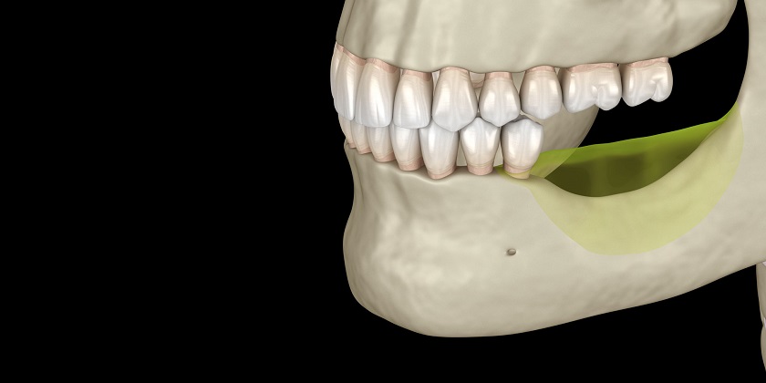 Tiêu xương hàm do mất răng lâu năm