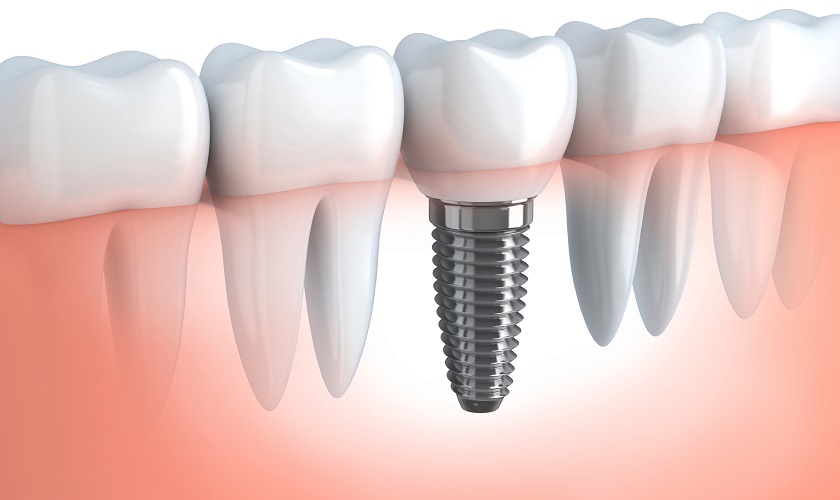 Quy trình cắm implant - Hậu quả mất răng lâu năm