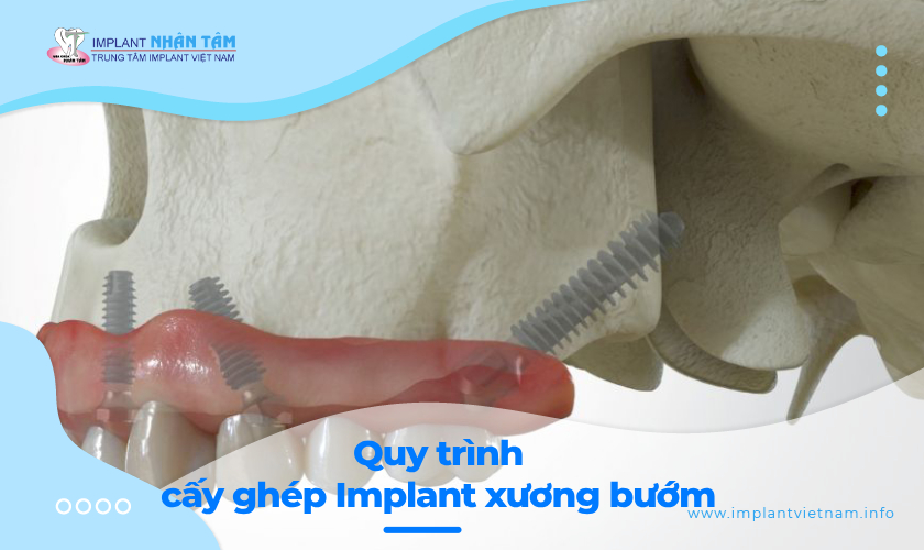 Quy trình cấy ghép Implant xương bướm