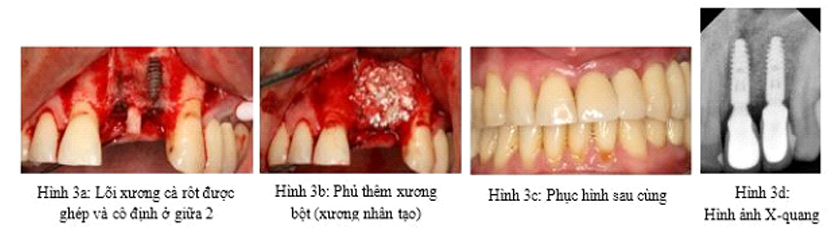 Tiến sĩ – Bác sĩ Võ Văn Nhân điều trị cho Khách hàng bị tiêu xương trầm trọng theo chiều dọc và chiều ngang