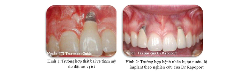 Lộ Implant do biến chứng viêm quanh Implant