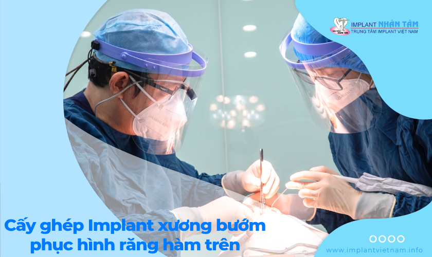 Phục hình răng hàm trên với kỹ thuật Implant xương bướm