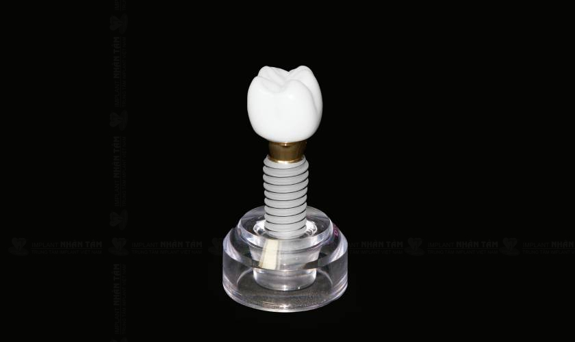 Trụ Implant Nobel Active được đánh giá cao trong điều trị phục hồi răng hàm trên bằng kỹ thuật Implant xương bướm